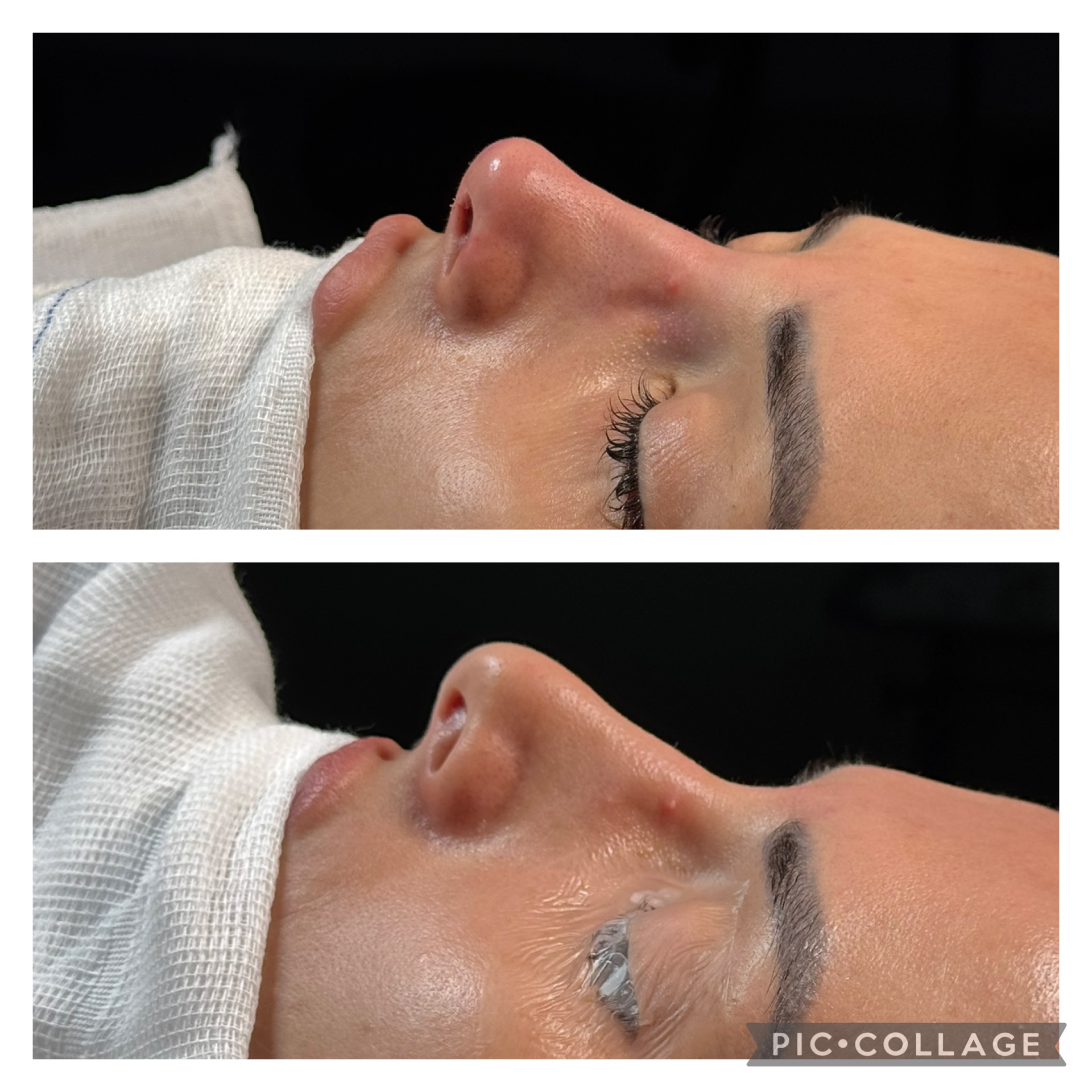 Resultado de rinoplastia — caso clínico 1