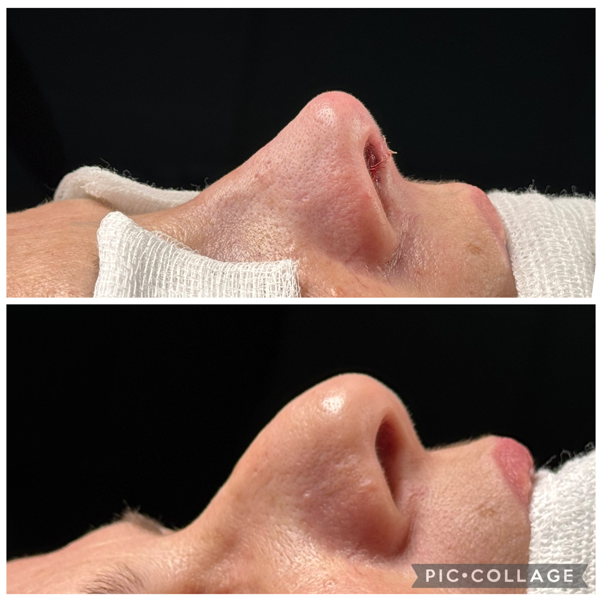 Resultado de rinoplastia — caso clínico 2