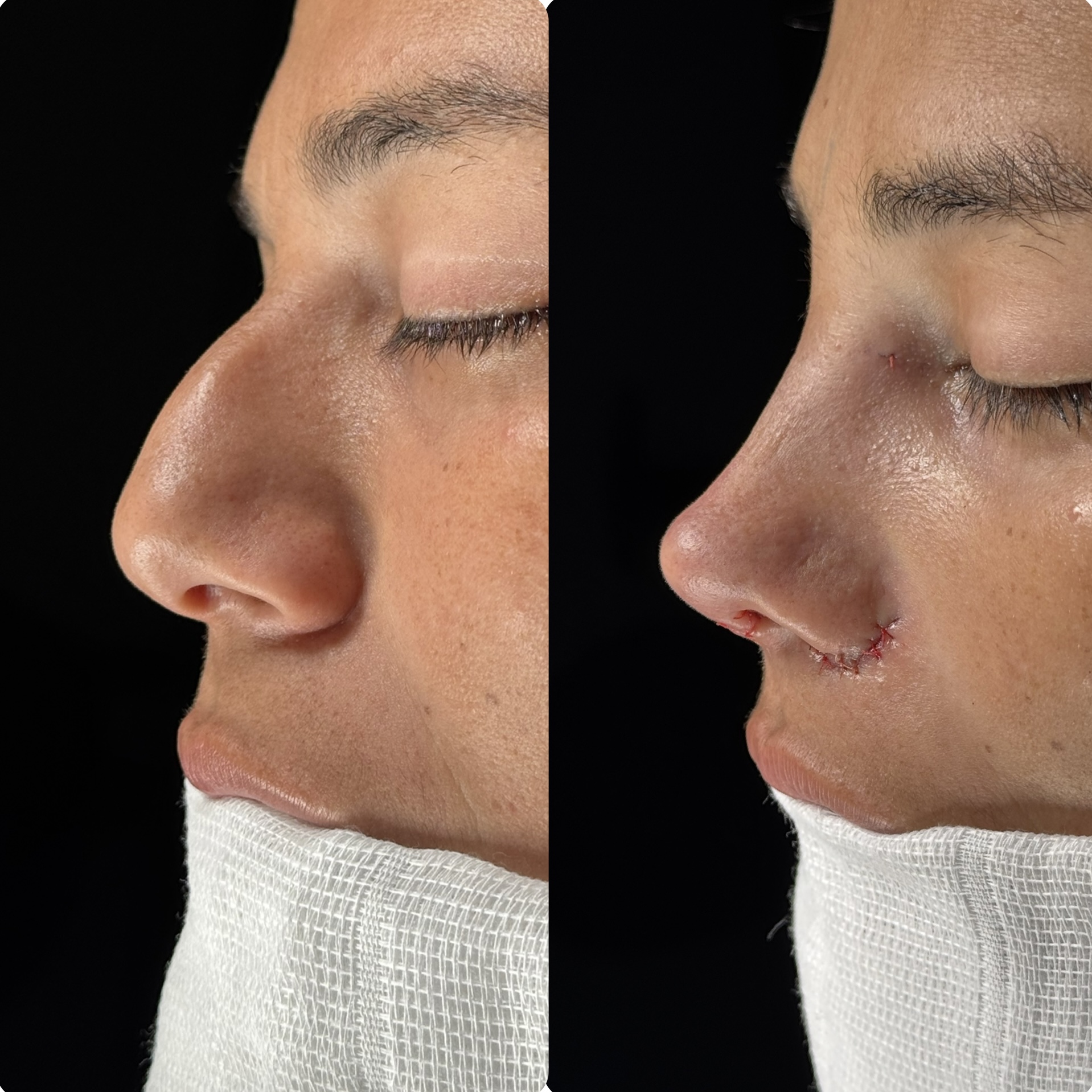 Resultado de rinoplastia — caso clínico 3