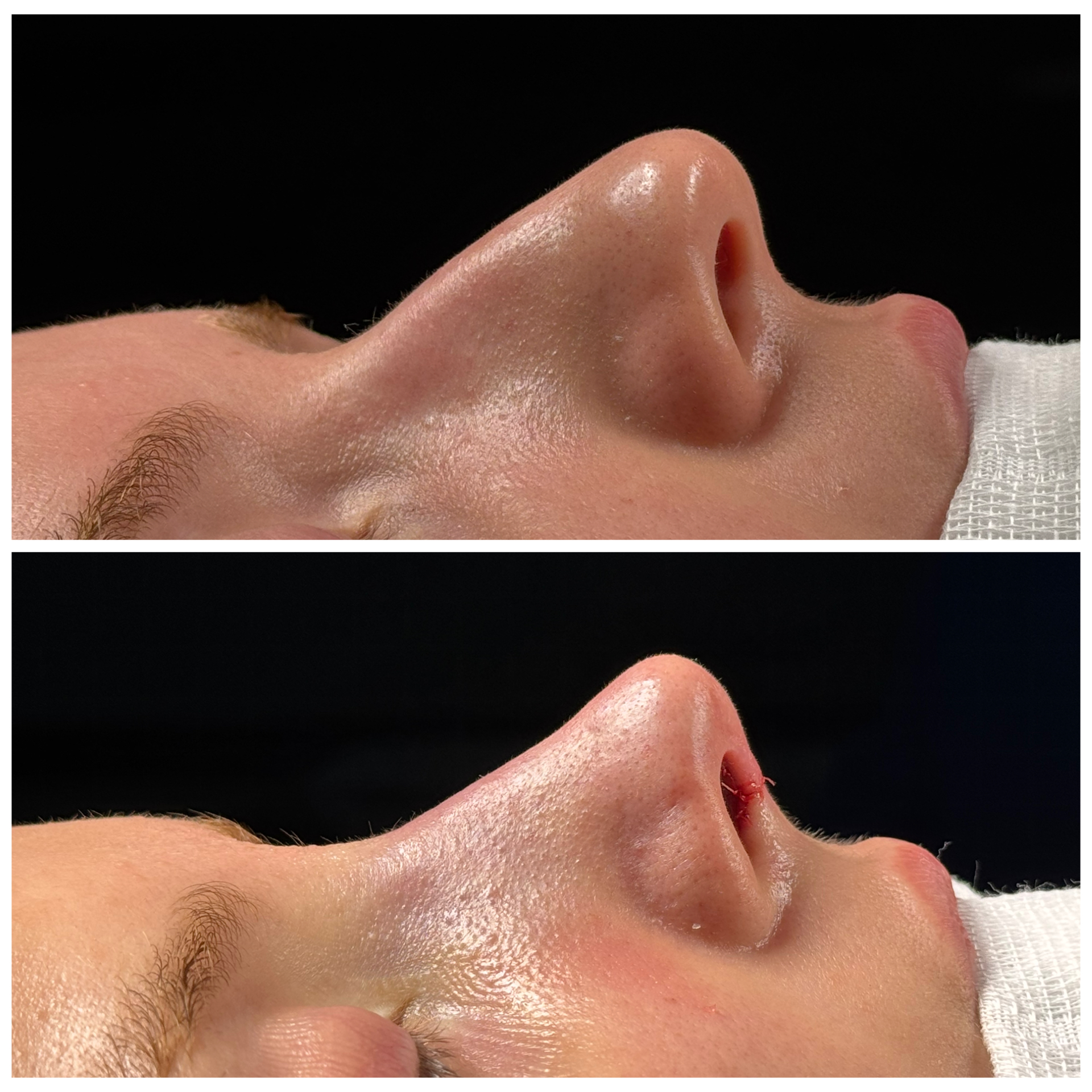Resultado de rinoplastia — caso clínico 4