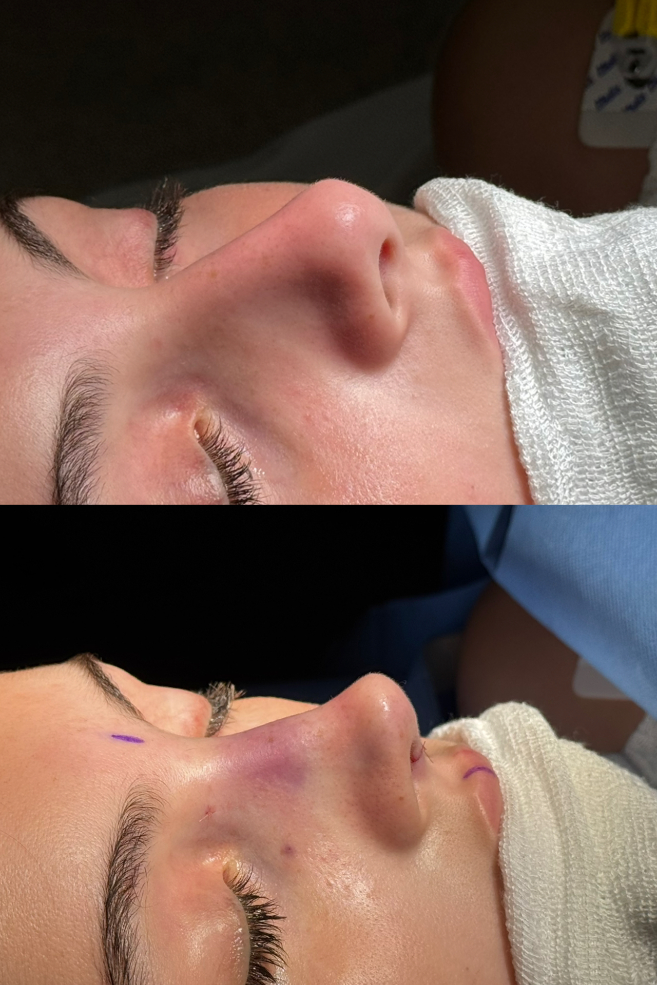 Resultado de rinoplastia — caso clínico 5
