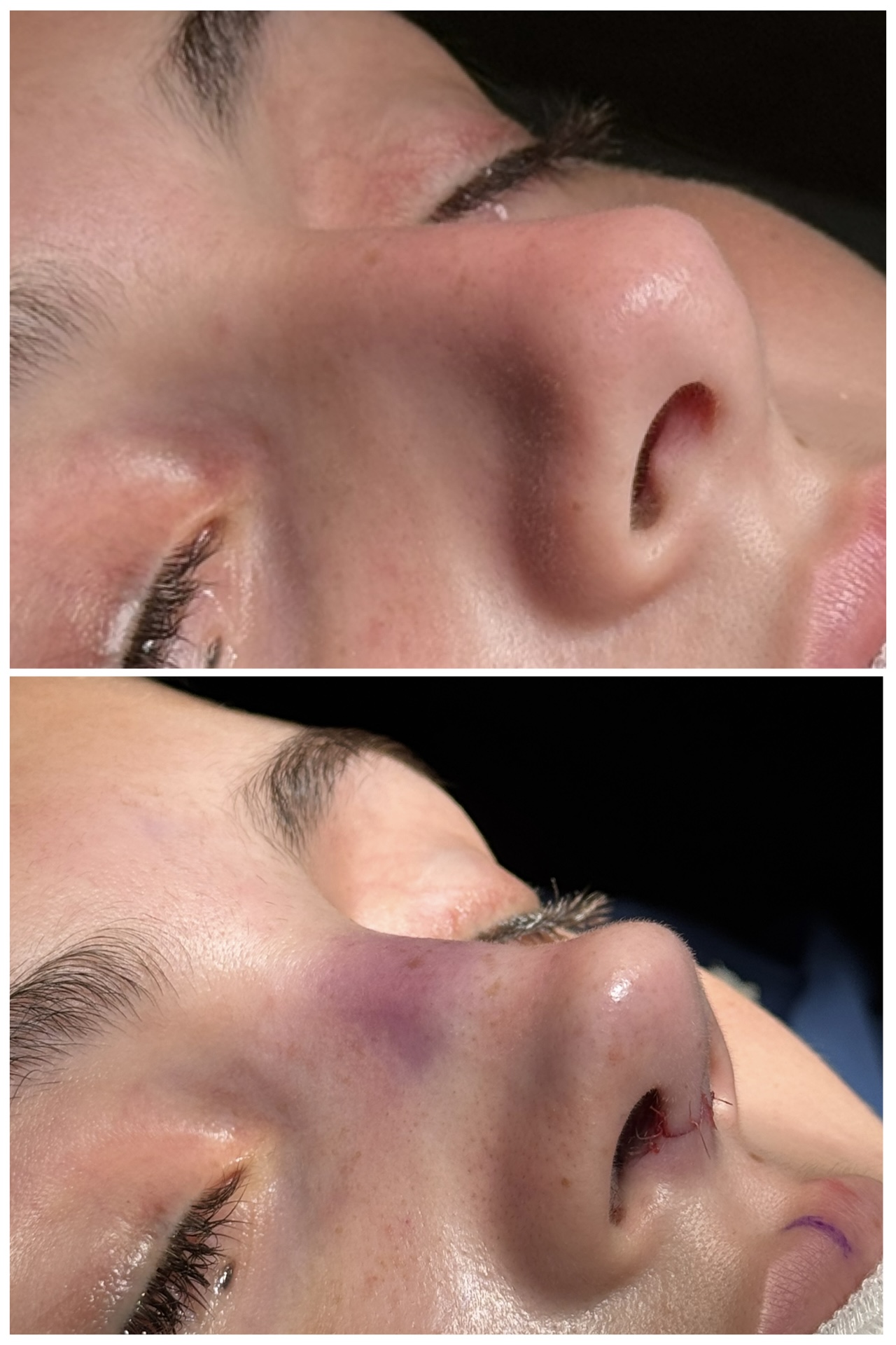 Resultado de rinoplastia — caso clínico 6