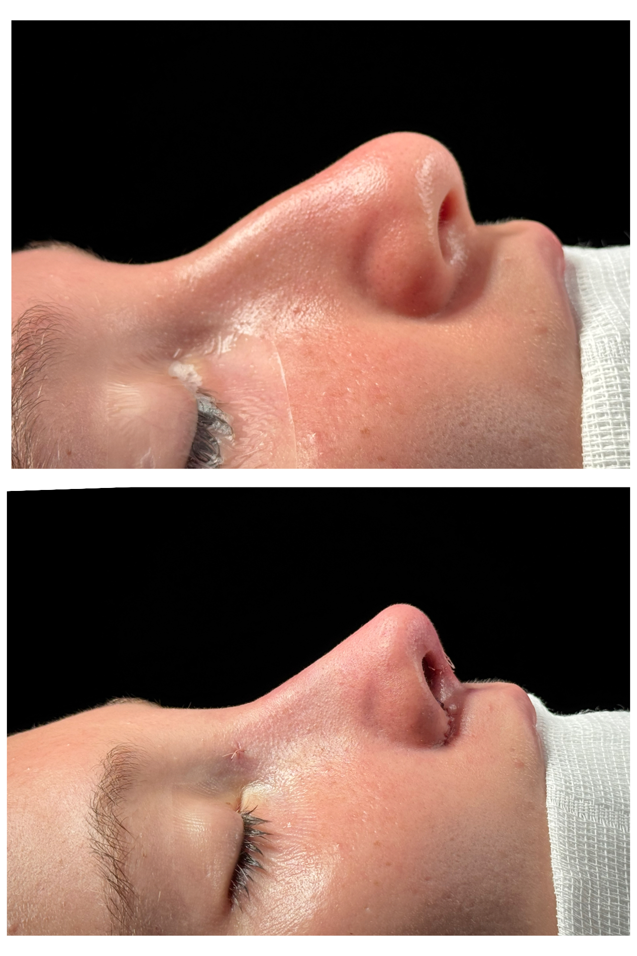 Resultado de rinoplastia — caso clínico 7