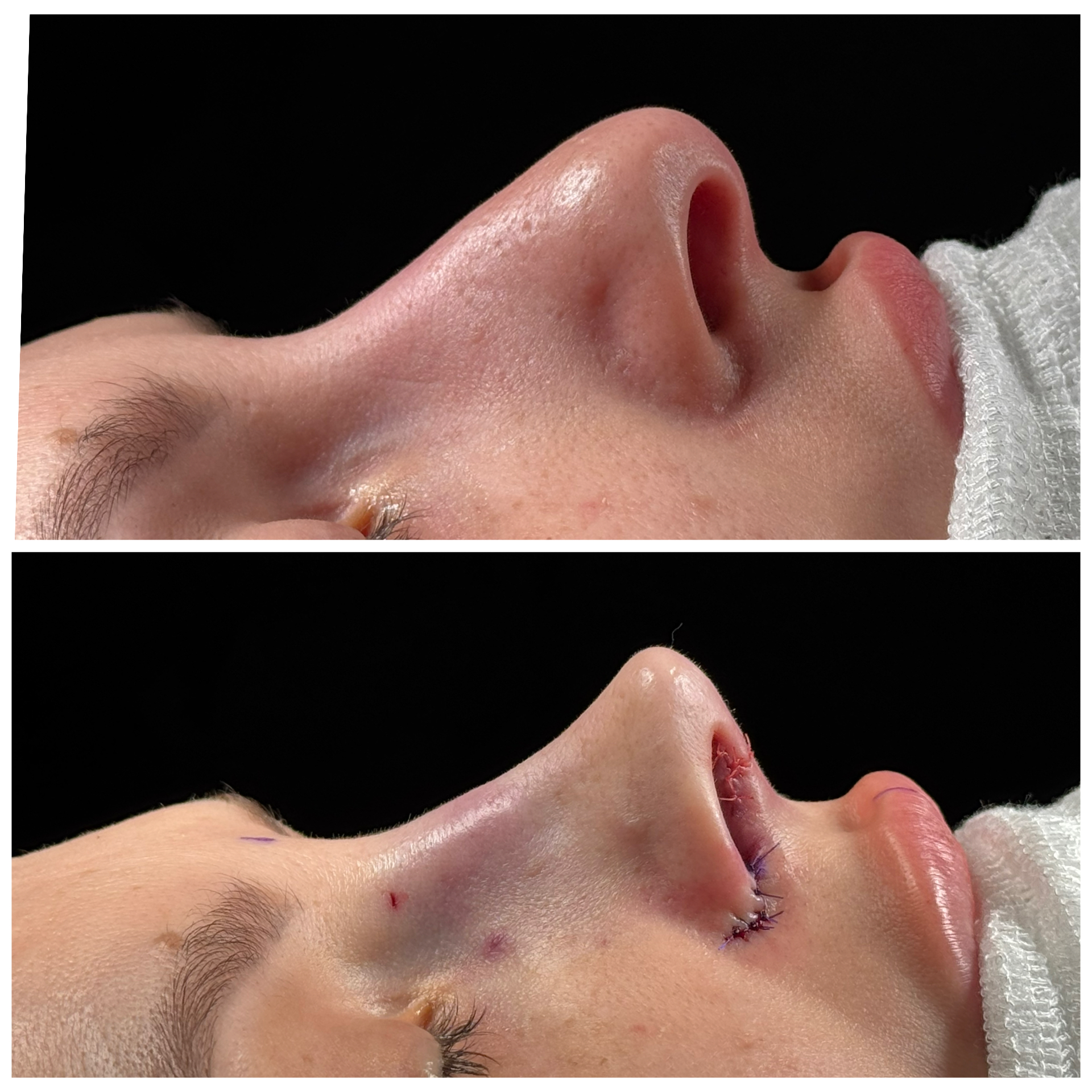 Resultado de rinoplastia — caso clínico 8