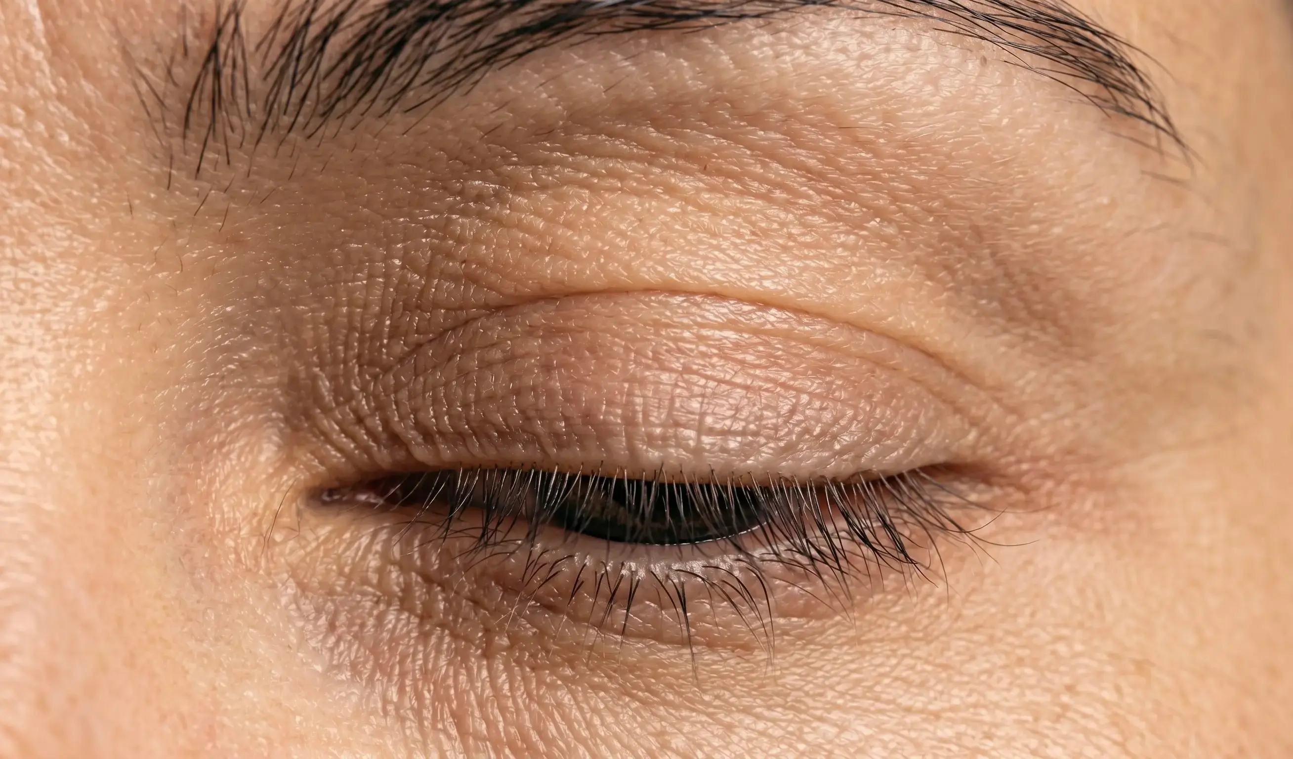 Blefaroplastia — Dr. Ícaro Pires
